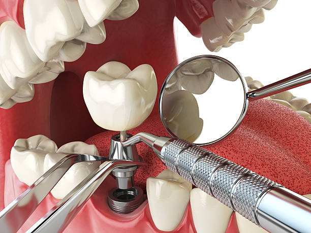 Best Emergency Root Canal Treatment in Dexter, GA